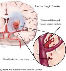 hemorrhagic_stroke.jpg