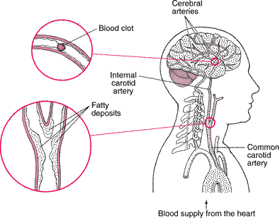 arteries-stroke.gif